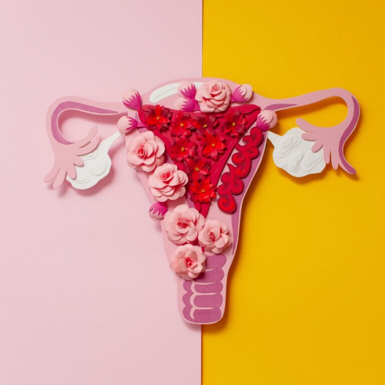 A endometriose é uma doença ginecológica crônica em que o tecido endometrial gera inflamação nos ovários, intestino, bexiga, trompas